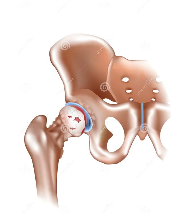 Anatomical illustration of hip osteoarthritis showing cartilage loss, joint space narrowing, and osteophyte formation in the hip joint