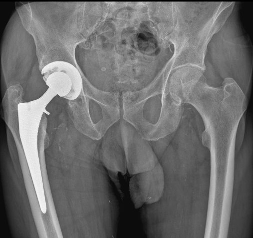 Post-operative AP pelvic X-ray showing successful total hip replacement with well-aligned prosthetic components restoring hip anatomy