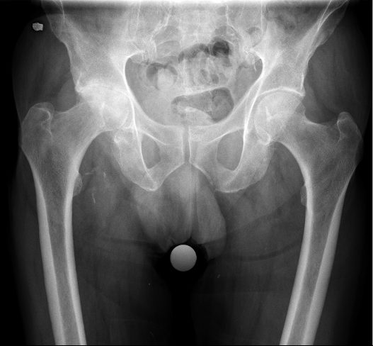 Pre-operative AP pelvic X-ray showing end-stage hip osteoarthritis with complete loss of joint space, subchondral sclerosis, and osteophytes