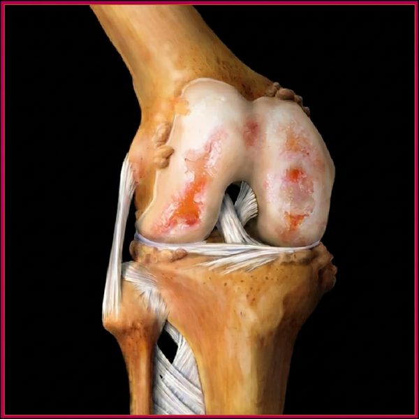 Anatomical illustration of knee osteoarthritis showing severe cartilage erosion, exposed bone surfaces, and ligament damage within the knee joint