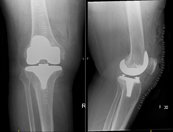 Post-operative AP and lateral knee X-rays showing successful total knee replacement with well-aligned femoral and tibial components restoring the mechanical axis