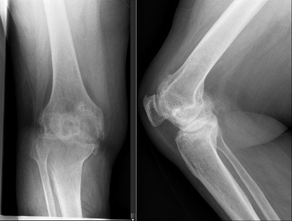 Pre-operative AP and lateral knee X-rays showing end-stage knee osteoarthritis with complete medial joint space loss, subchondral sclerosis, and varus deformity