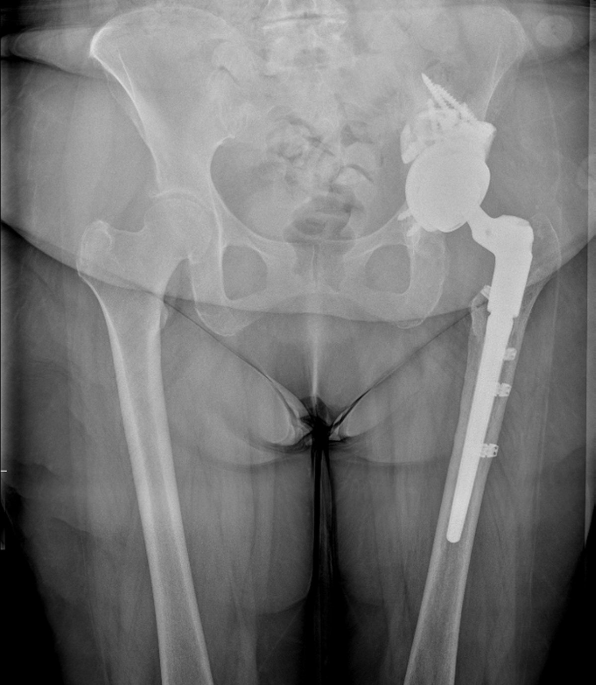 Post-operative pelvic x-ray after second-stage complex acetabular reconstruction with multiple augments