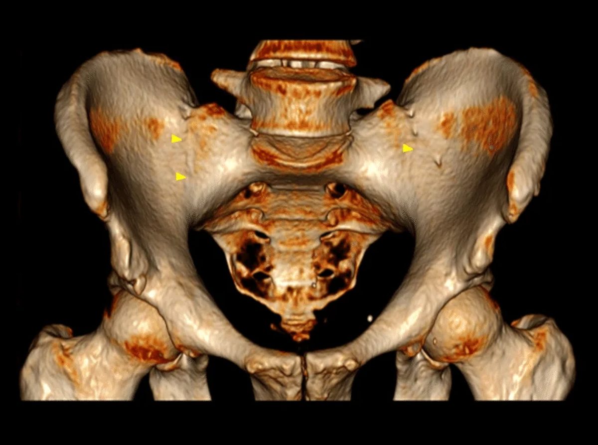 Anatomical illustration showing inflammation at the sacroiliac joints and bilateral hip involvement in ankylosing spondylitis