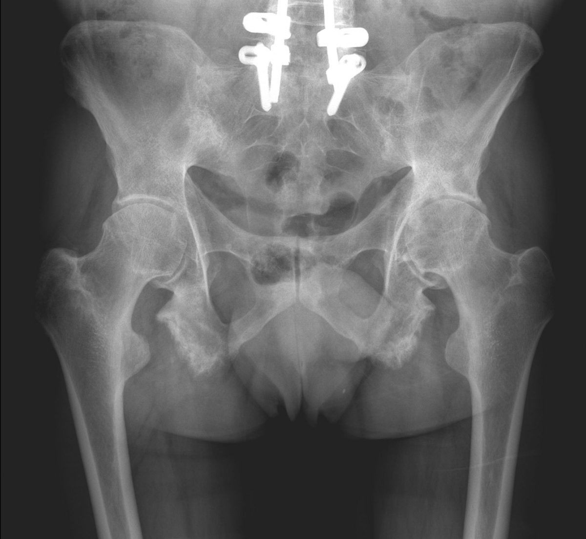 Pre-operative AP pelvic X-ray showing bilateral hip joint-space narrowing and sacroiliitis in ankylosing spondylitis, from Mr Hussain's clinical archive