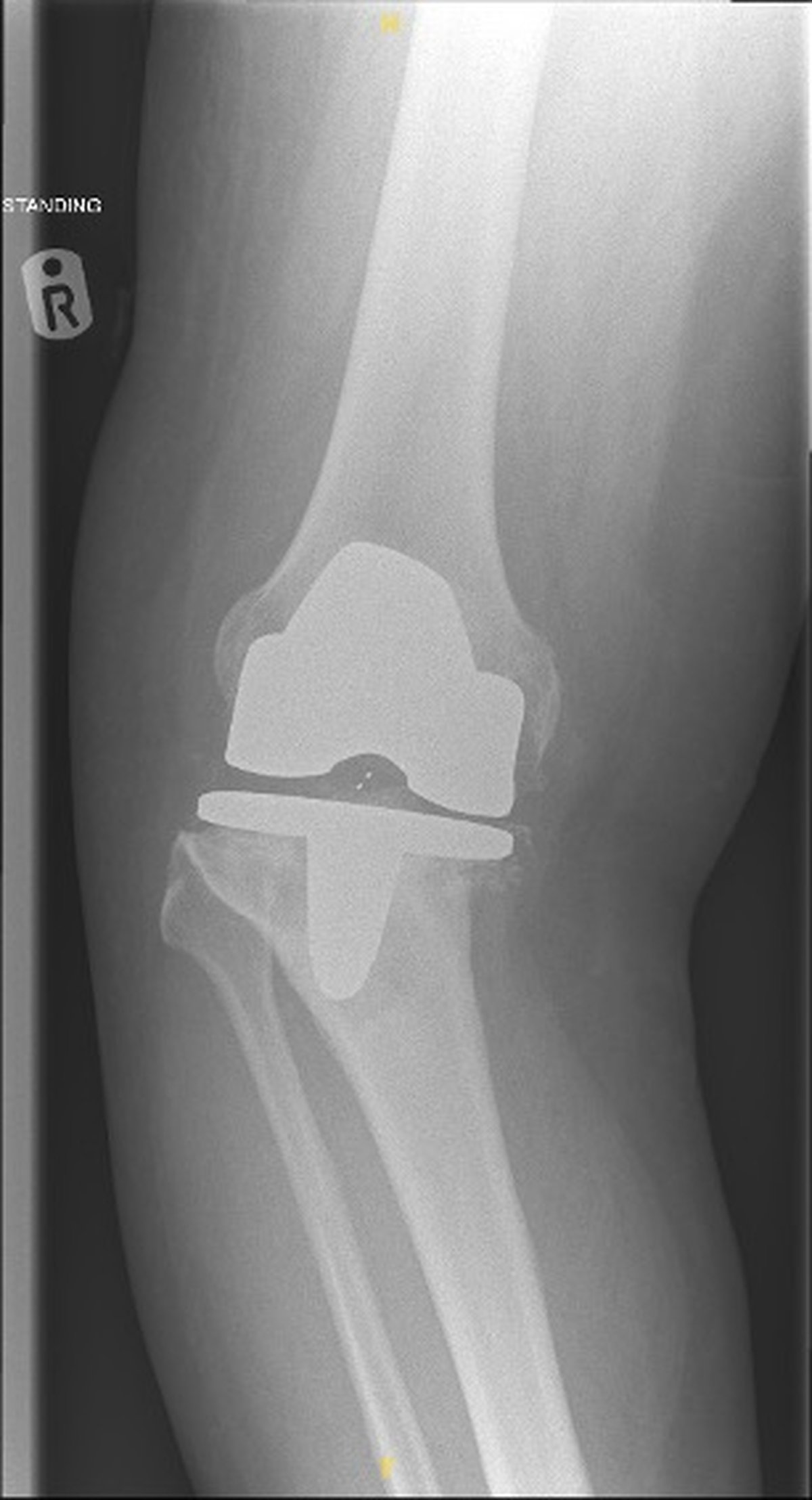 Pre-operative knee x-ray showing aseptic loosening of a 12-year-old total knee replacement with severe deformity and medial tibial bone loss