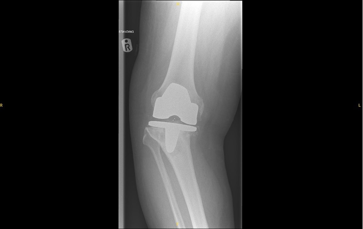X-ray of an aseptically loosened total knee replacement after 12 years, with severe deformity and medial tibial bone loss, before revision knee replacement surgery in Birmingham