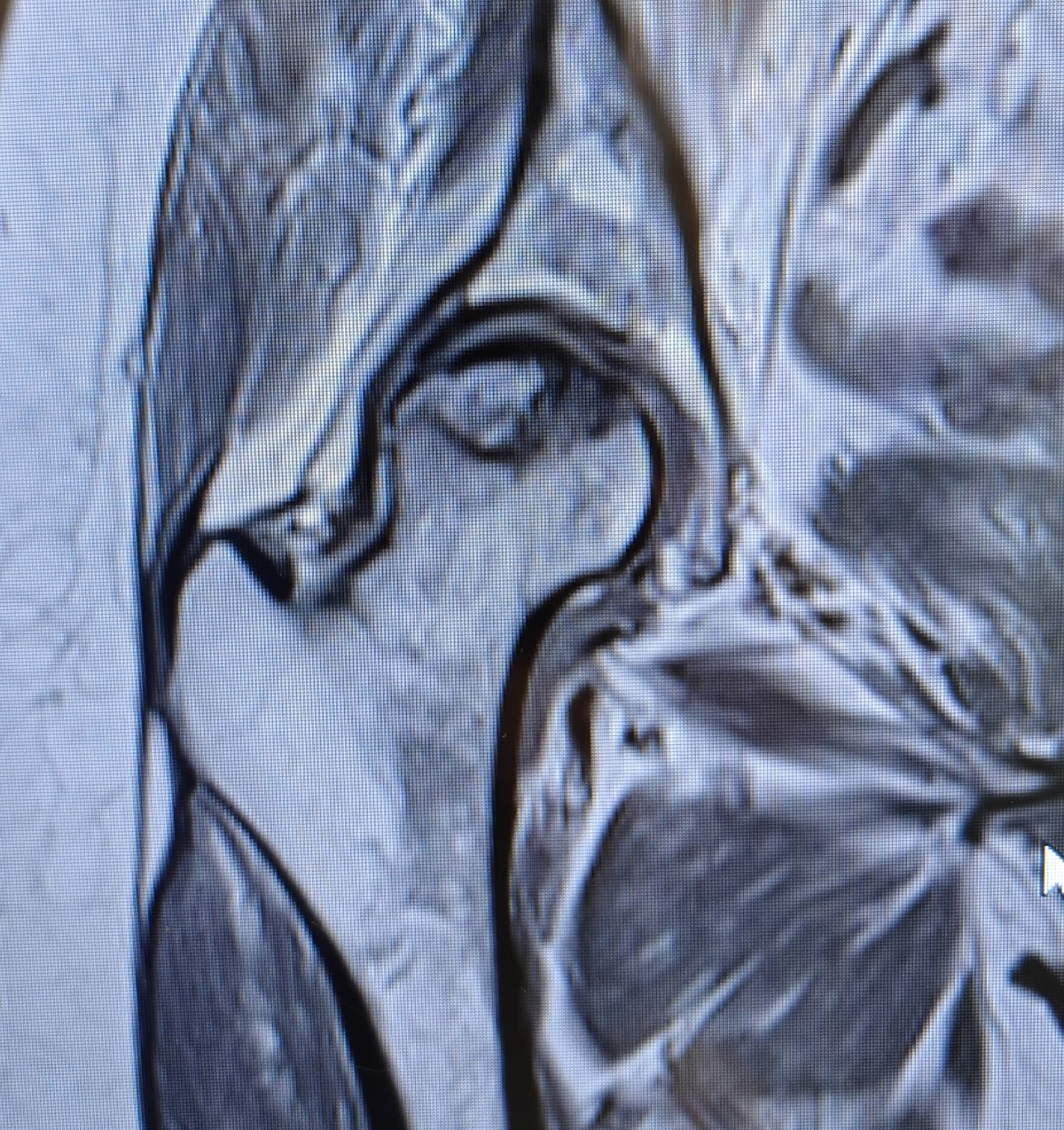 Coronal MRI scan of the hip showing avascular necrosis of the femoral head with characteristic serpiginous demarcation line, the gold-standard imaging test for diagnosing AVN