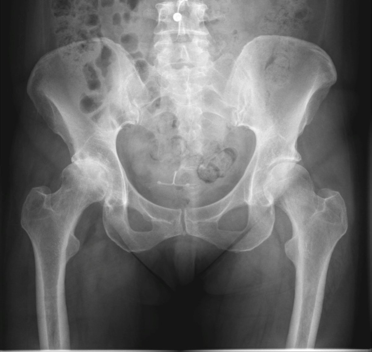 Pre-operative pelvic x-ray showing bilateral hip osteoarthritis with joint space narrowing on both sides