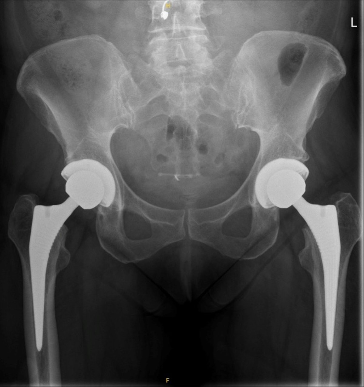 Post-operative pelvic x-ray after bilateral total hip replacement showing well-positioned implants in both hips