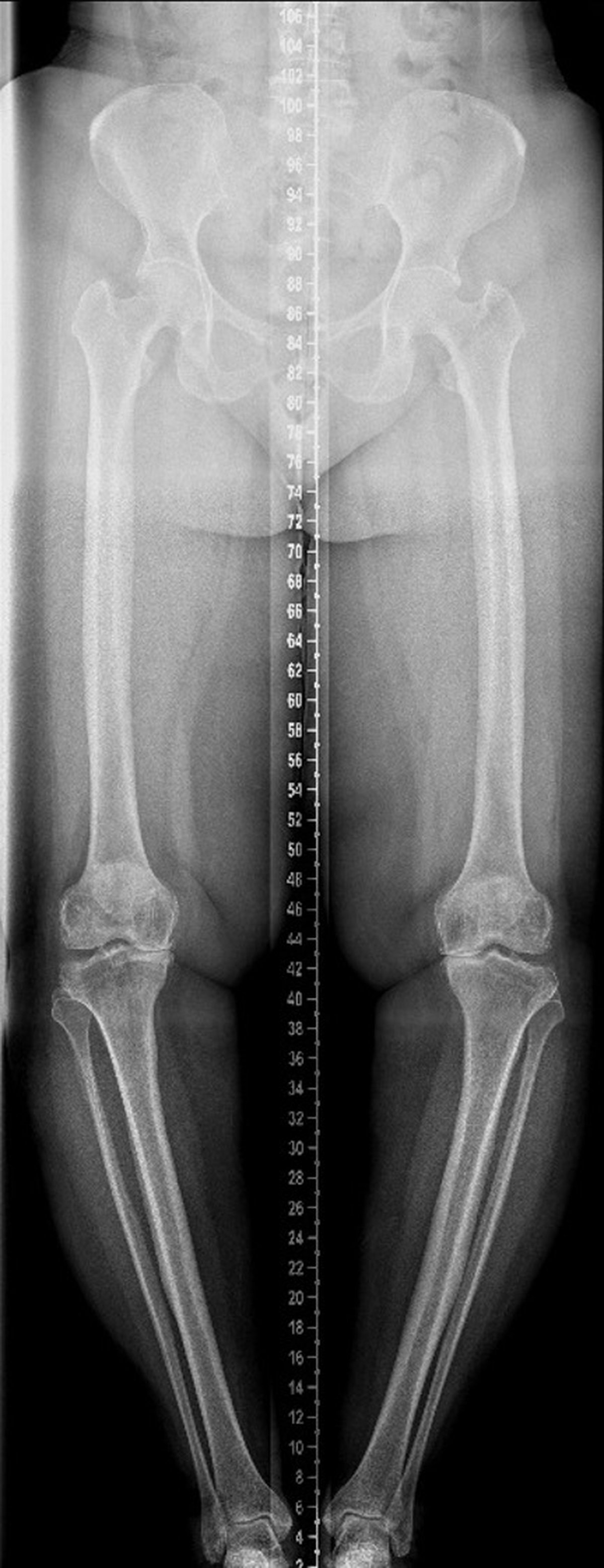 Pre-operative long-leg standing x-ray showing moderate varus deformity of both knees