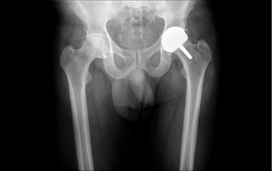 Post-operative X-ray of a Birmingham Hip Resurfacing performed by Mr Shakir Hussain at the Royal Orthopaedic Hospital Birmingham