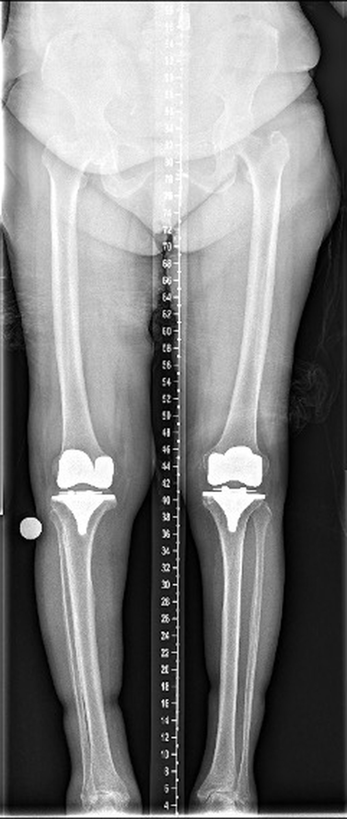 Post-operative long-leg standing x-ray after staged bilateral knee replacement showing good correction of severe varus alignment