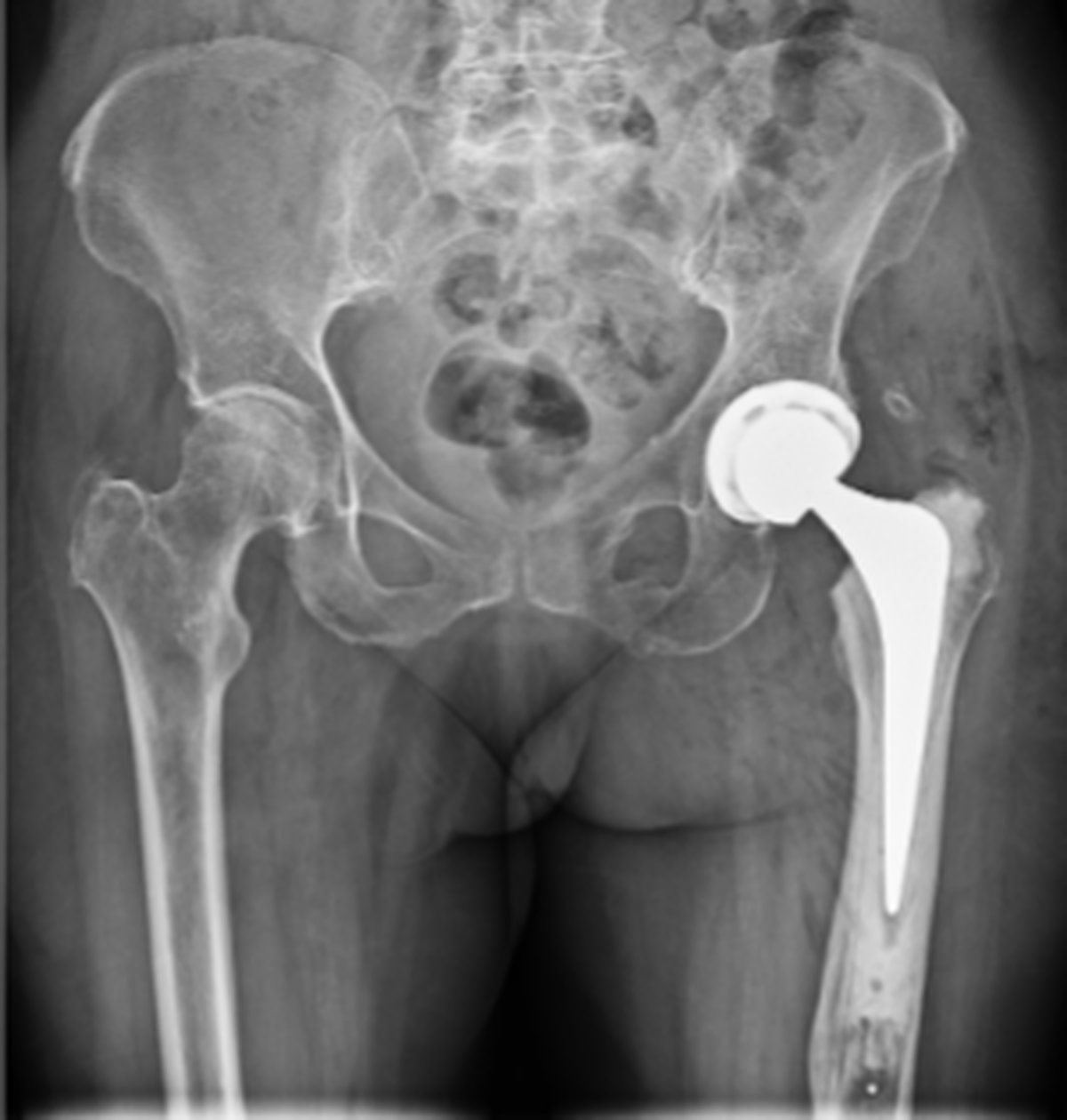 Post-operative hip x-ray after removal of the femoral nail and complex primary hip replacement