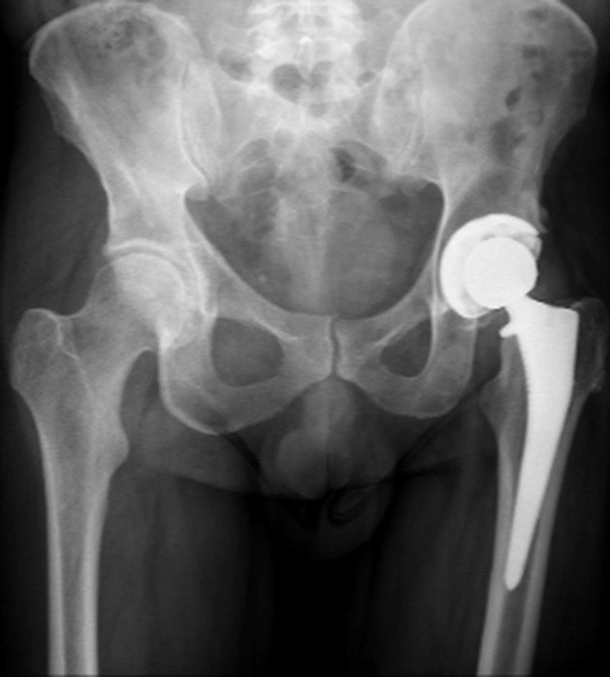 Post-operative hip x-ray after removal of the dynamic hip screw and complex primary hip replacement