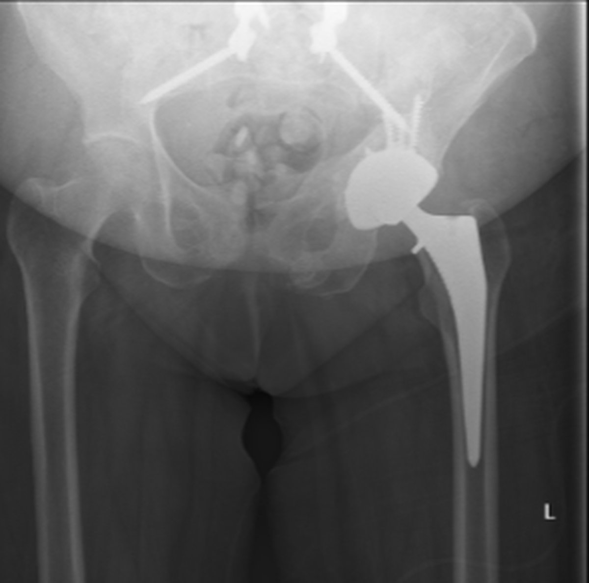 Post-operative pelvic x-ray after complex hip replacement in a patient with previous spinal fusion