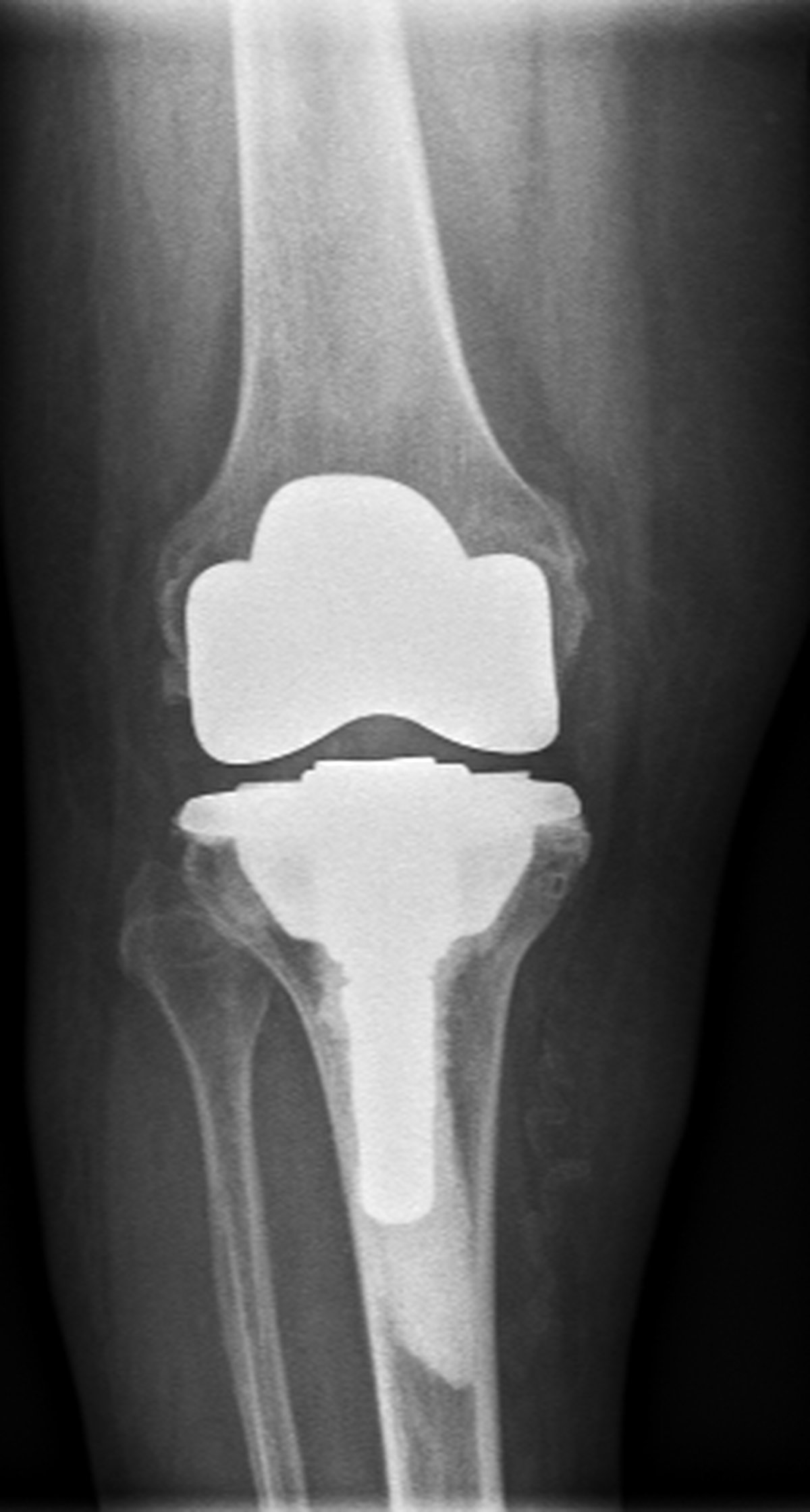 Post-operative knee x-ray after complex knee replacement with restored alignment and corrected deformity