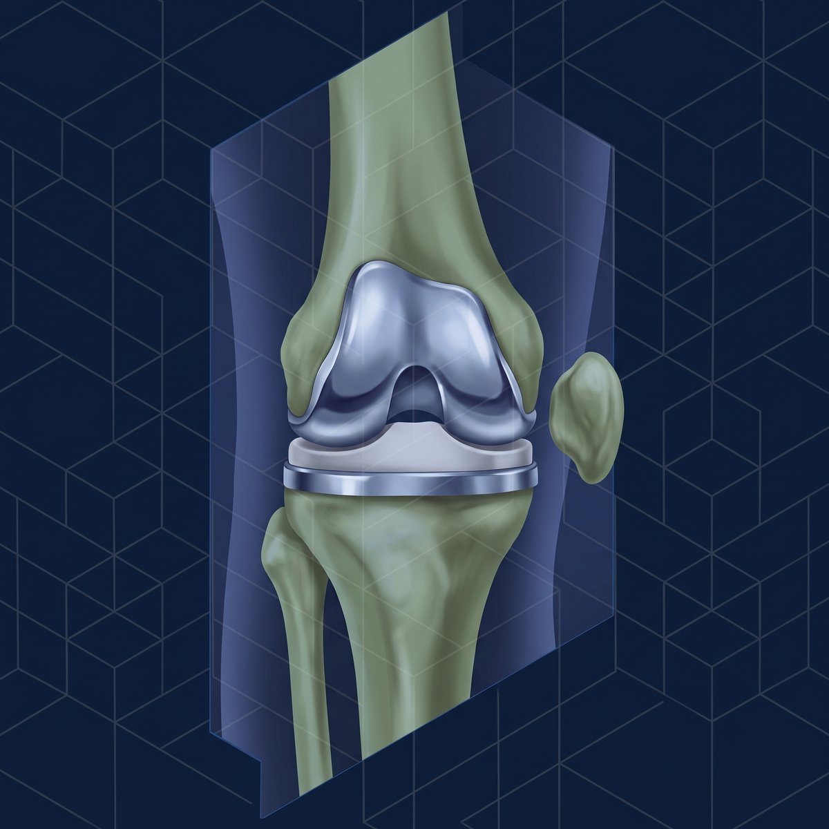 Complex knee replacement illustration showing femoral and tibial implant components, Mr Shakir Hussain, Consultant Knee Surgeon Birmingham