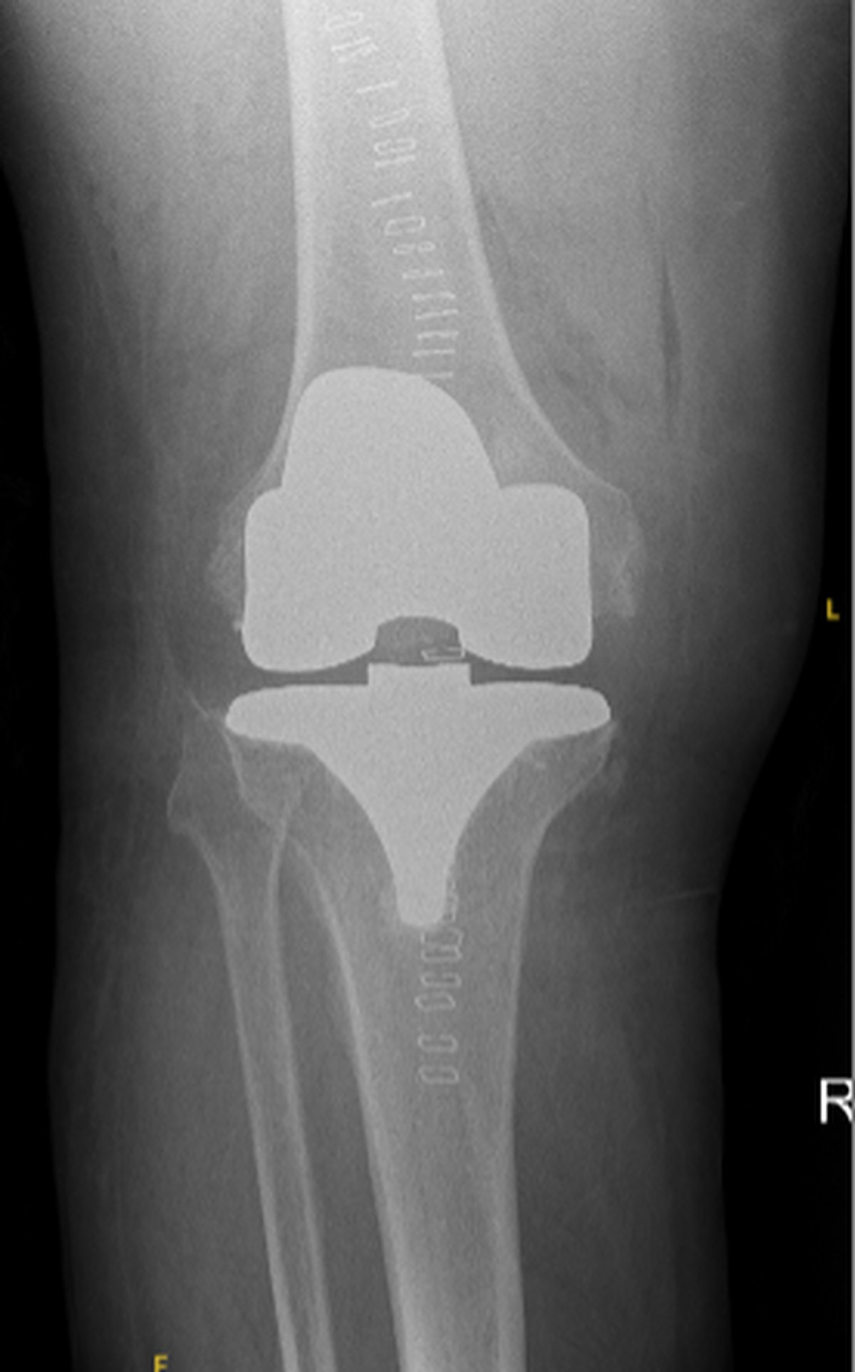 Post-operative knee x-ray after complex knee replacement reconstruction using standard implants with restored alignment