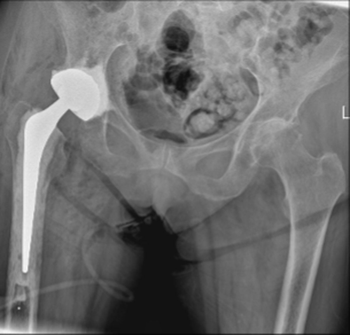 Post-operative pelvic x-ray after complex primary hip replacement showing well-positioned implant and restored joint space
