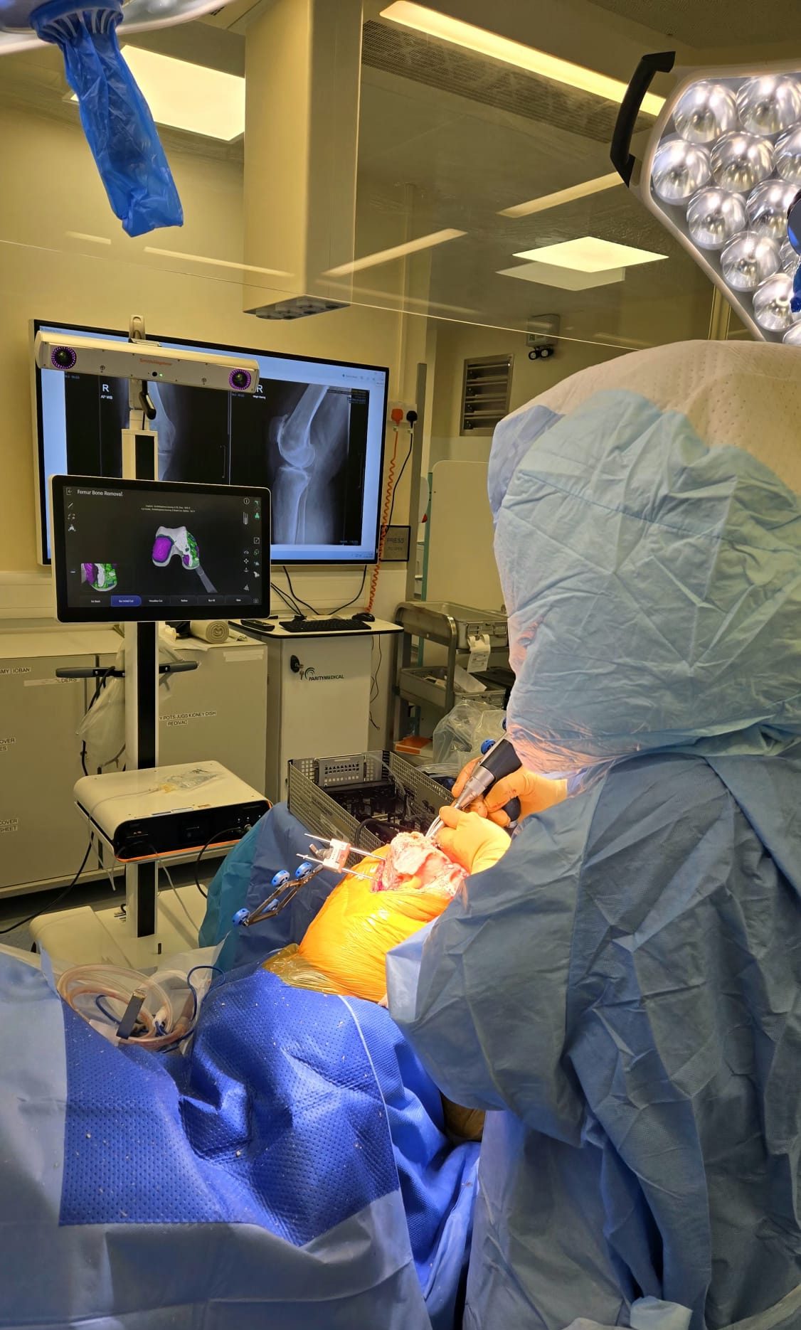 CORI robotic knee replacement in progress showing real-time 3D bone mapping and knee X-rays on navigation screens