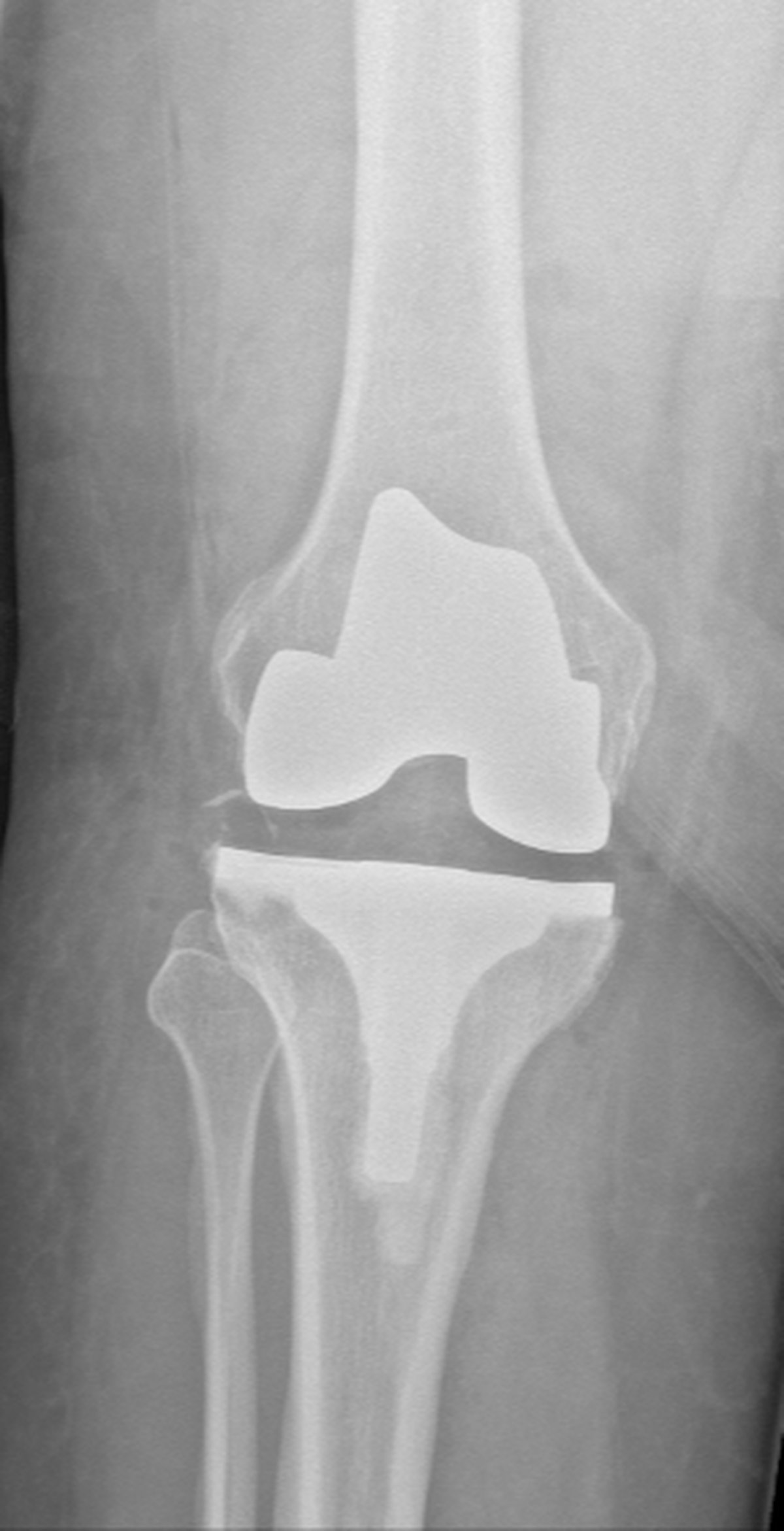 Post-operative knee x-ray after total knee replacement performed using the CORI robotic platform with well-positioned implant