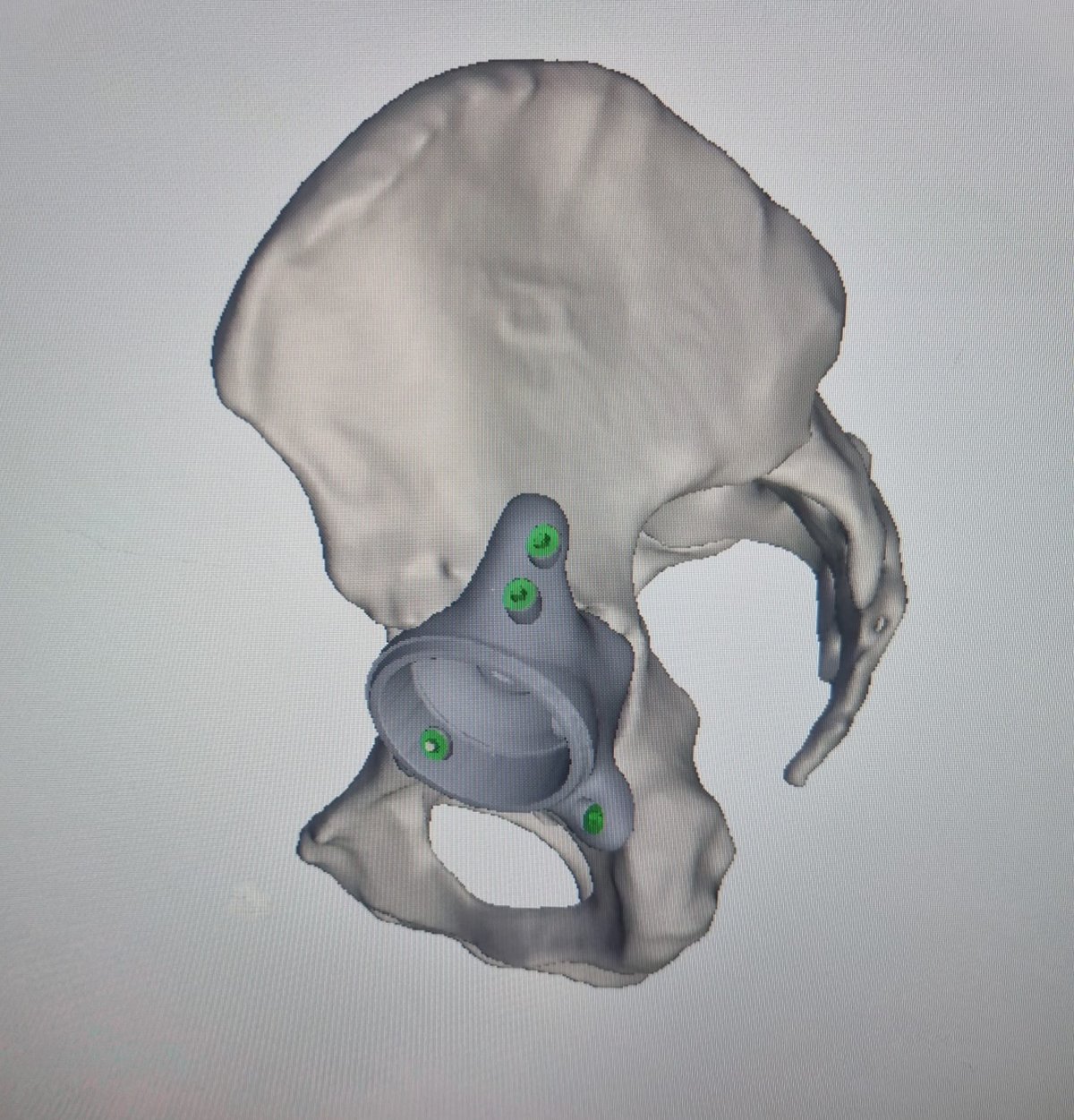 Three-dimensional planning model of a custom acetabular implant for a complex hip replacement, fixed with screws into the pelvis