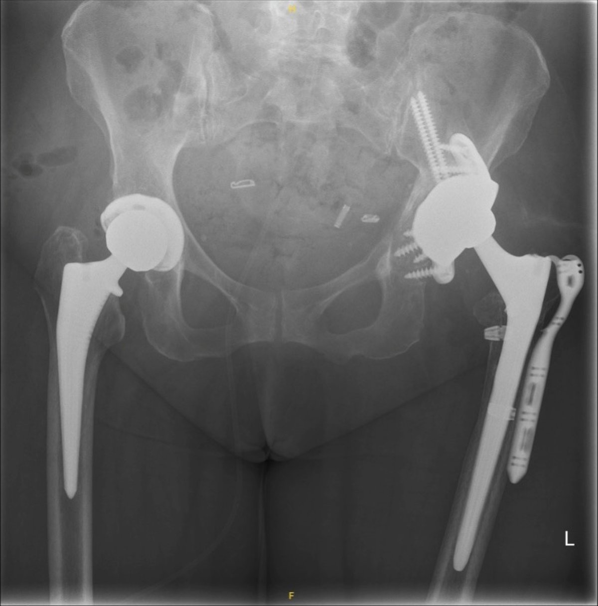 Post-operative pelvic x-ray after staged bilateral reconstruction with a custom acetabular implant on the left hip and a total hip replacement on the right