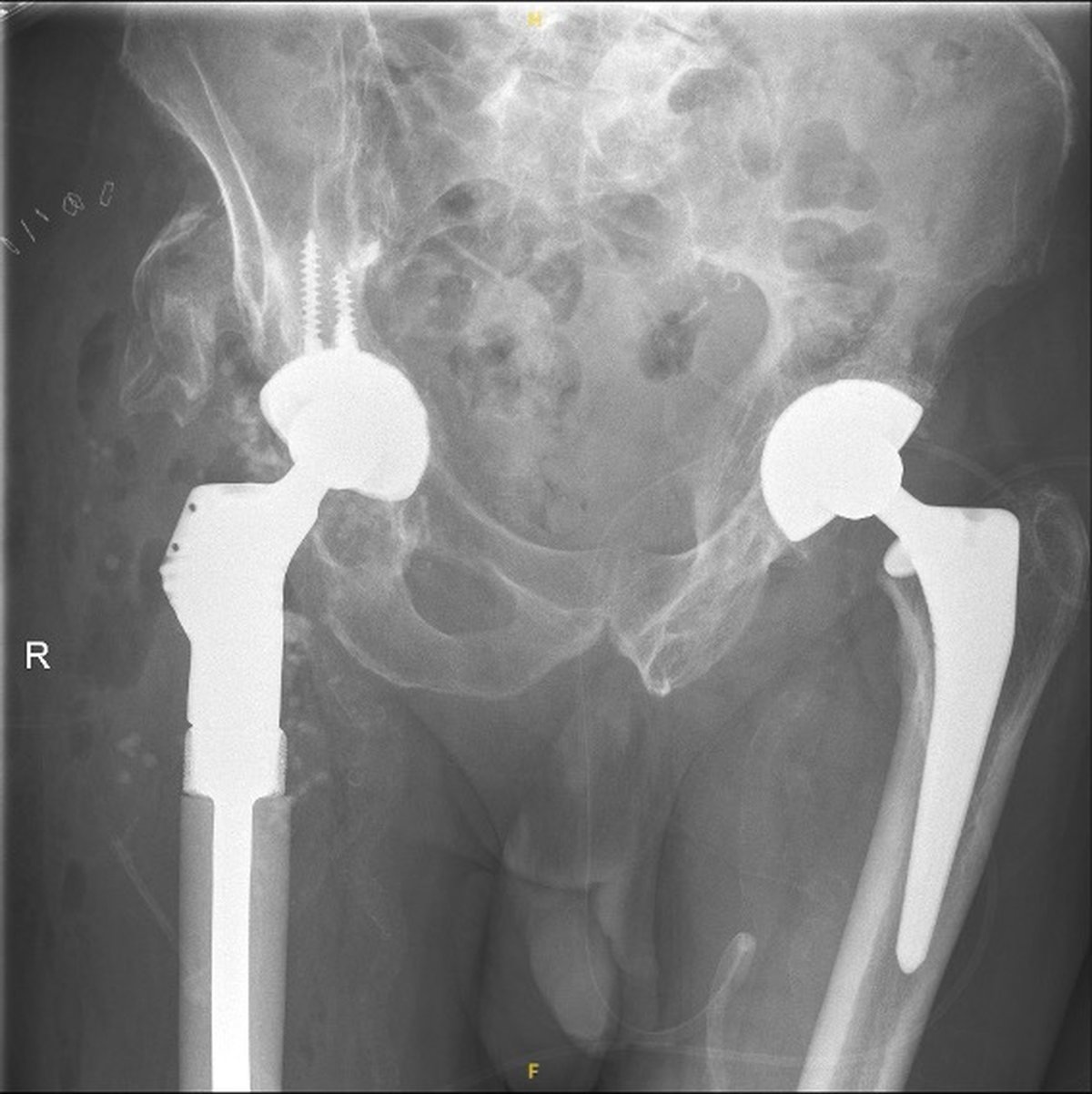 Post-operative pelvic x-ray after right hip reconstruction with a custom-made implant by Mr Hussain