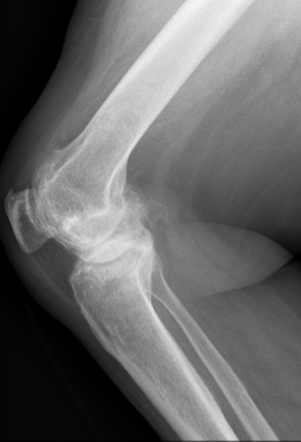 Pre-operative knee x-ray showing severe destructive osteoarthritis with marked joint destruction and very limited range of motion