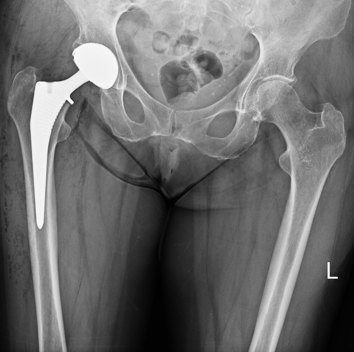 Post-operative x-ray of a dual mobility total hip replacement performed for a patient at high risk of dislocation