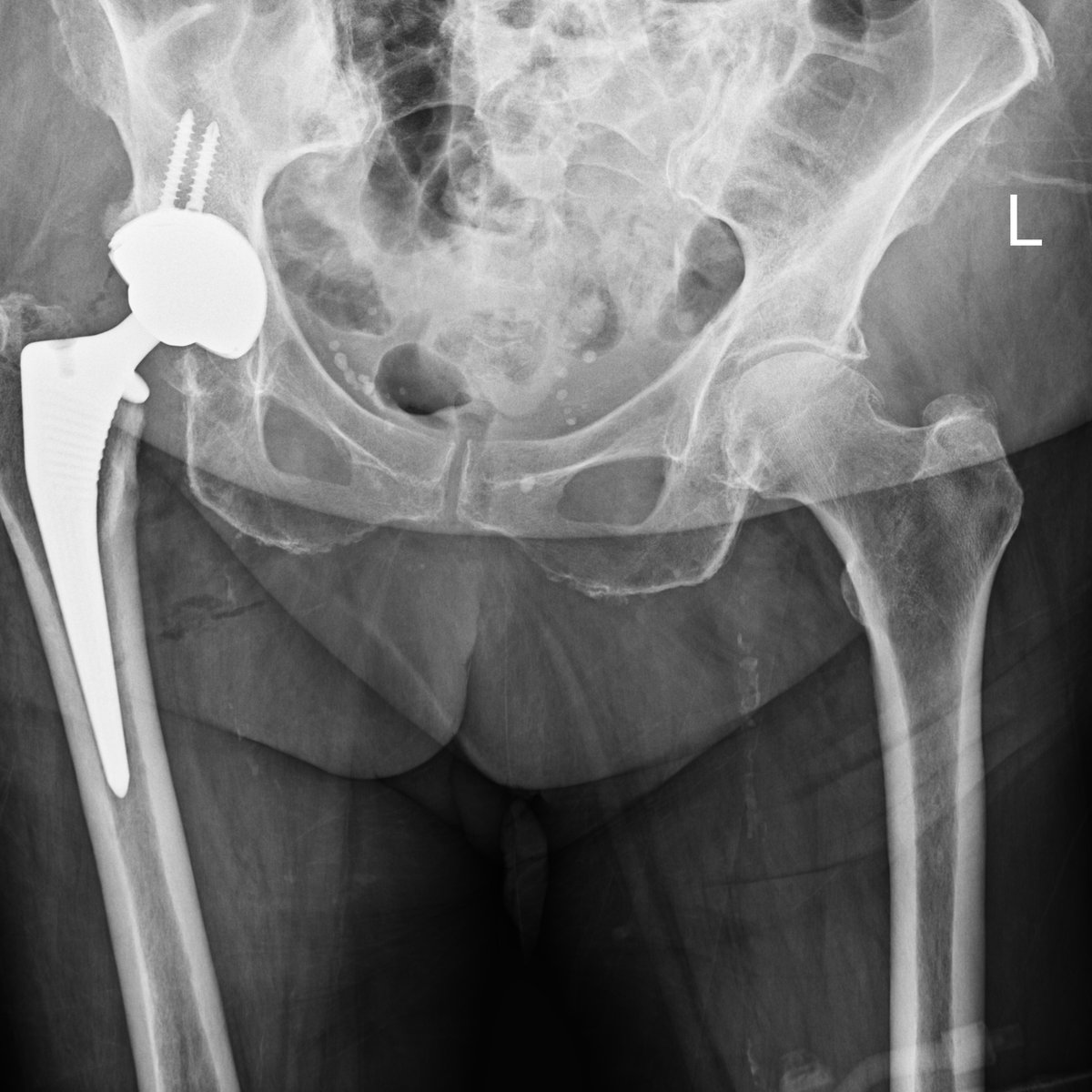 Post-operative x-ray after OR3O dual mobility hip replacement with the acetabular cup secured by screws