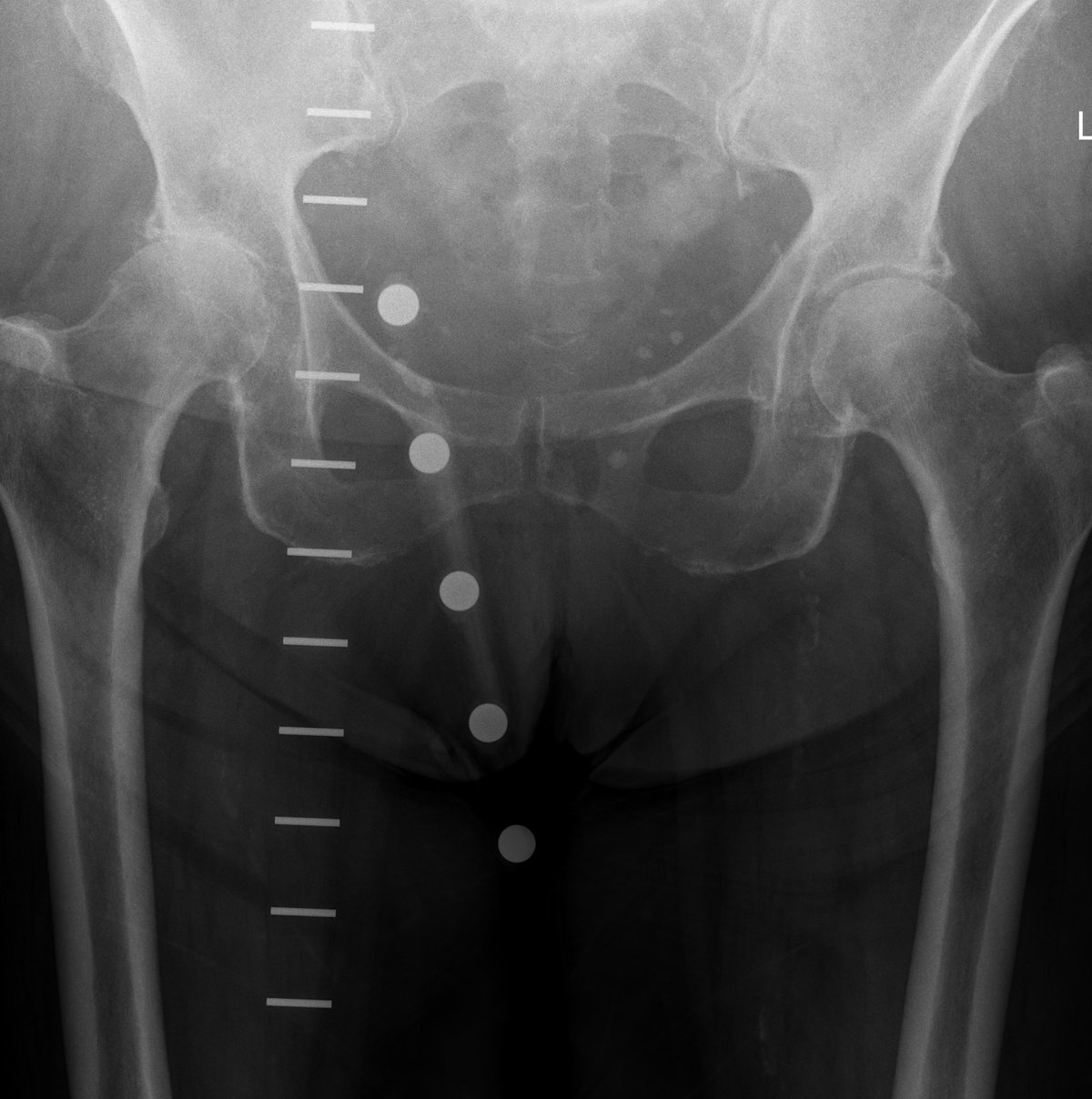 Pre-operative pelvic x-ray before dual mobility hip replacement showing severe arthritis of the right hip in an elderly patient