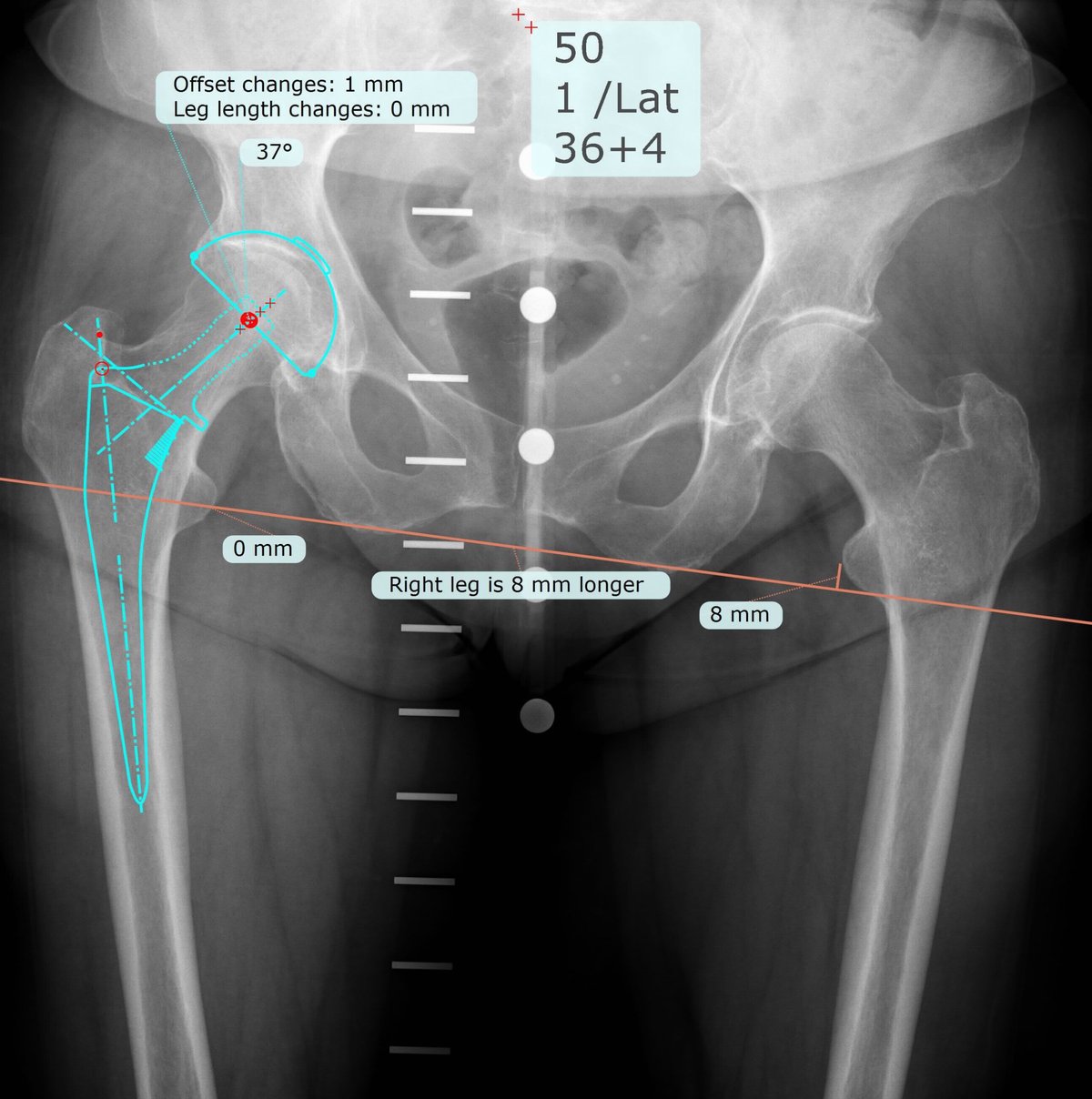 Digital templating x-ray planning a dual mobility hip replacement, showing implant sizing and leg length measurements