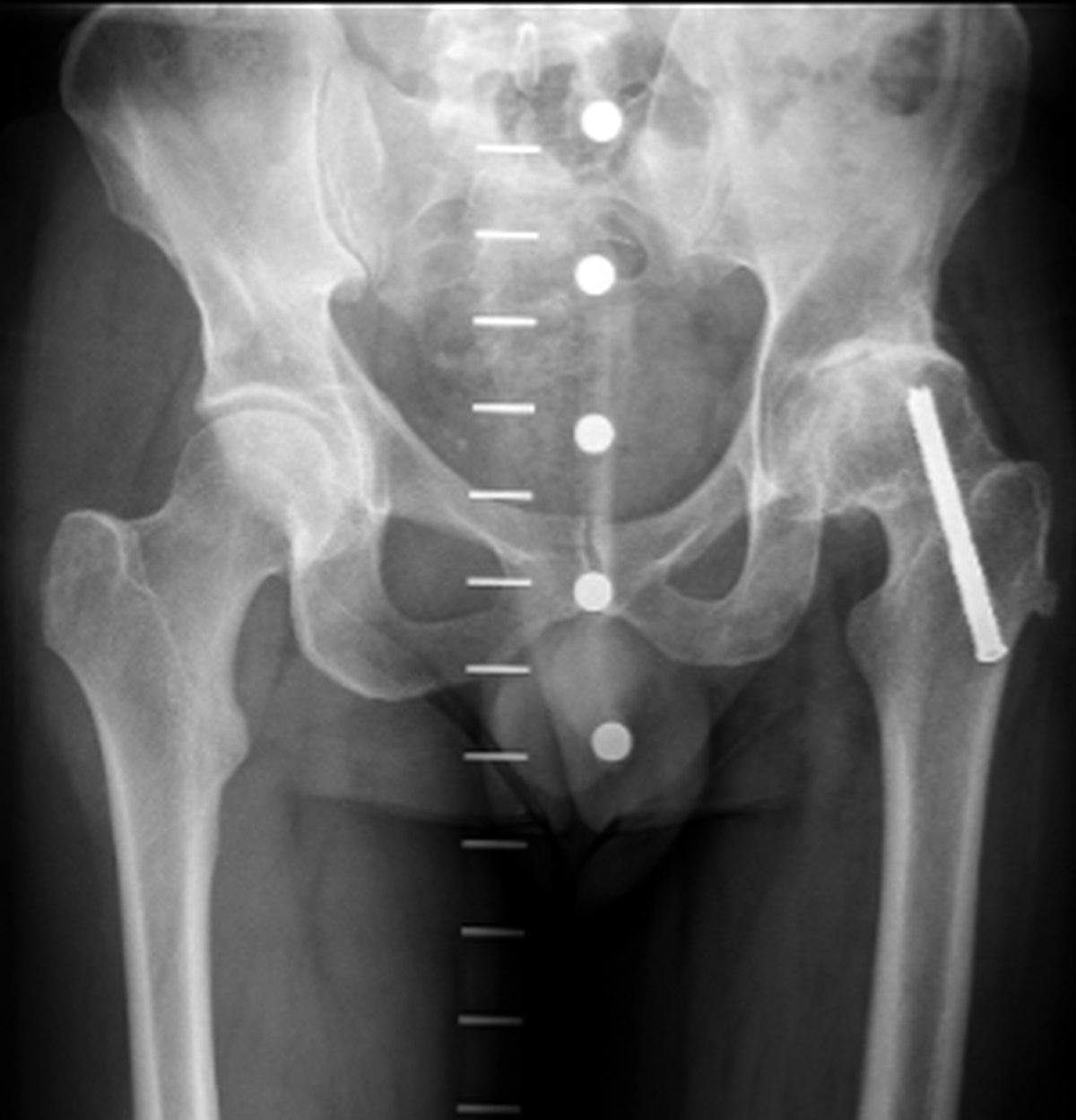 Pre-operative hip x-ray showing a dynamic hip screw in place from a previous fracture fixation
