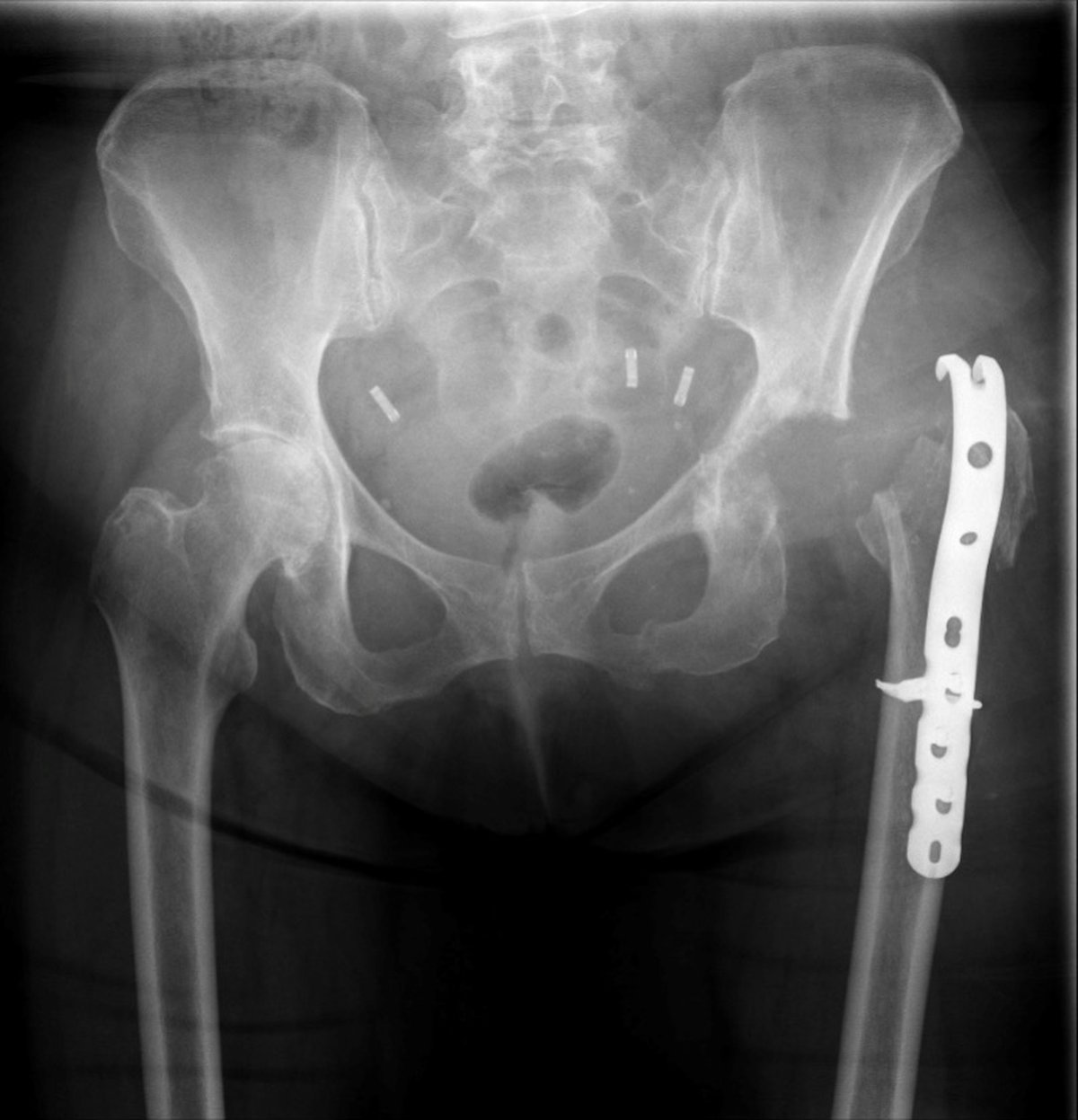 Pre-operative pelvic x-ray after a failed hip revision elsewhere, showing massive bone loss of the femur and acetabulum