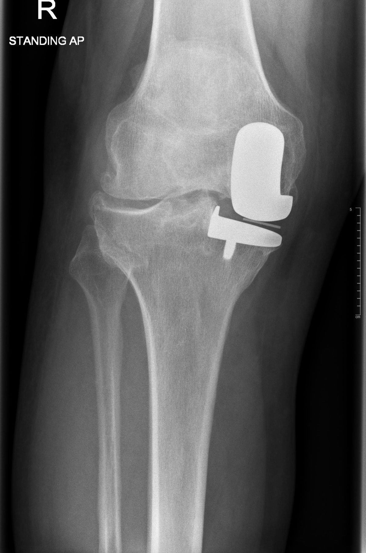 Pre-operative x-ray showing a failed partial knee replacement with arthritis progressing across the rest of the knee, before revision knee replacement in Birmingham