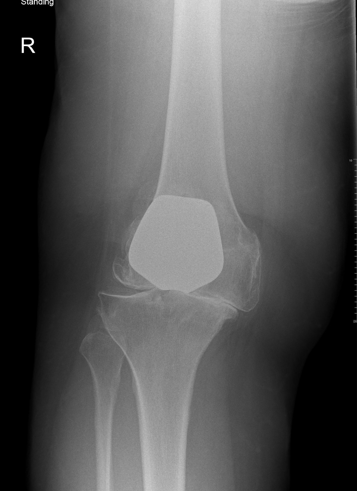 Standing x-ray showing severe knee arthritis 16 years after patellofemoral replacement, before CORI robotic conversion to total knee replacement