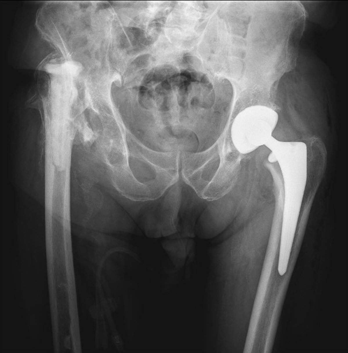 Pre-operative pelvic x-ray showing right hip Girdlestone state with absent femoral head following previous excision arthroplasty elsewhere