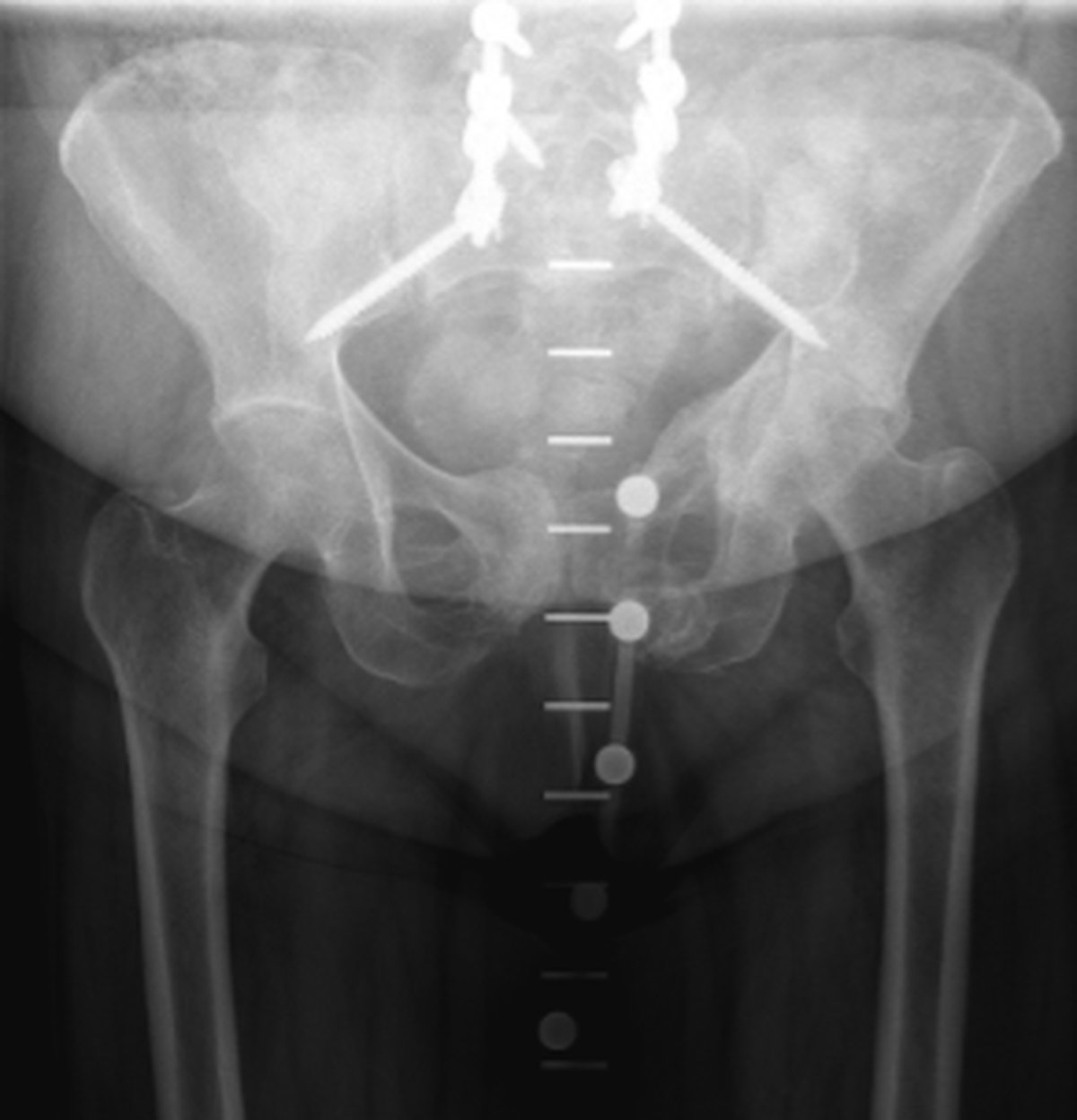 Pre-operative pelvic x-ray showing hip arthritis in a patient with previous spinal fusion