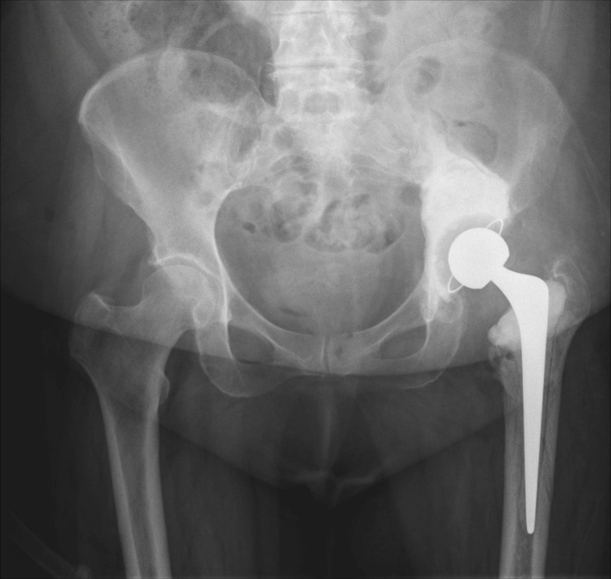 Pelvic x-ray after first-stage revision with infected implant removal and articulating antibiotic spacer in place