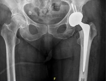 Post-operative AP pelvic X-ray following total hip replacement with internal fixation for a displaced left femoral neck fracture, from Mr Hussain's clinical archive
