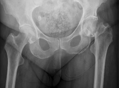 Pre-operative AP pelvic X-ray showing a displaced intracapsular femoral neck fracture of the left hip, from Mr Hussain's clinical archive