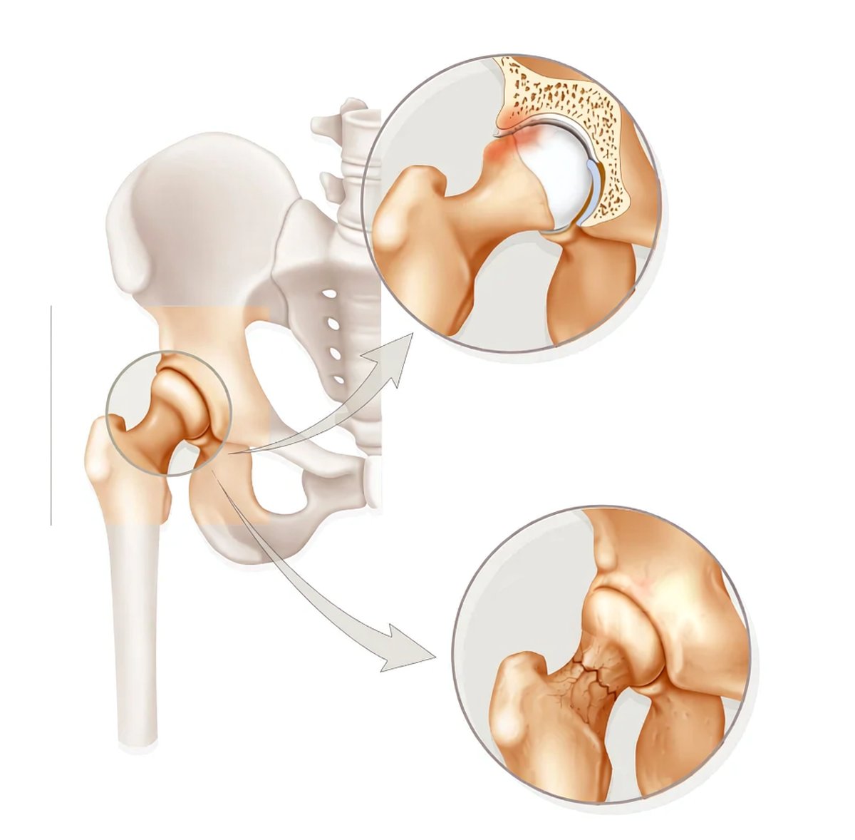 Anatomical illustration of hip impingement showing the normal hip, cam impingement with an aspherical femoral head, and pincer impingement with over-coverage of the acetabular rim