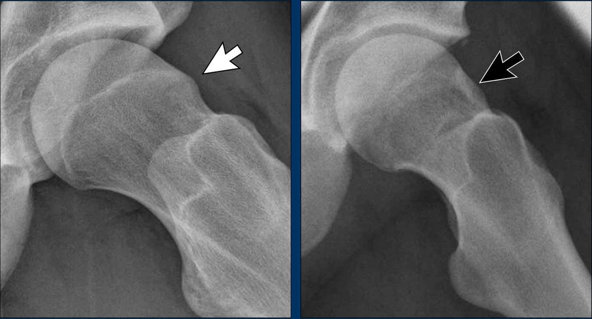 Dunn view X-ray of the hip showing cam-type femoroacetabular impingement with aspherical femoral head-neck junction and measured alpha angle