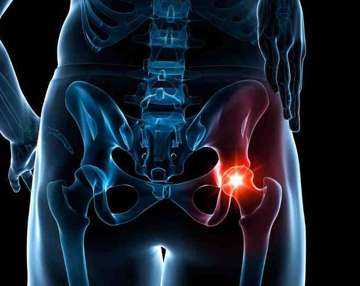 Anatomical illustration showing hip pain locations and referral patterns: groin pain from the joint itself, lateral pain from bursitis or gluteal tendon disease, buttock pain referred from the lumbar spine