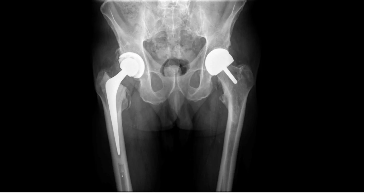 AP pelvis X-ray showing a total hip replacement and a hip resurfacing performed in the same patient by Mr Shakir Hussain, illustrating the bone preservation of resurfacing