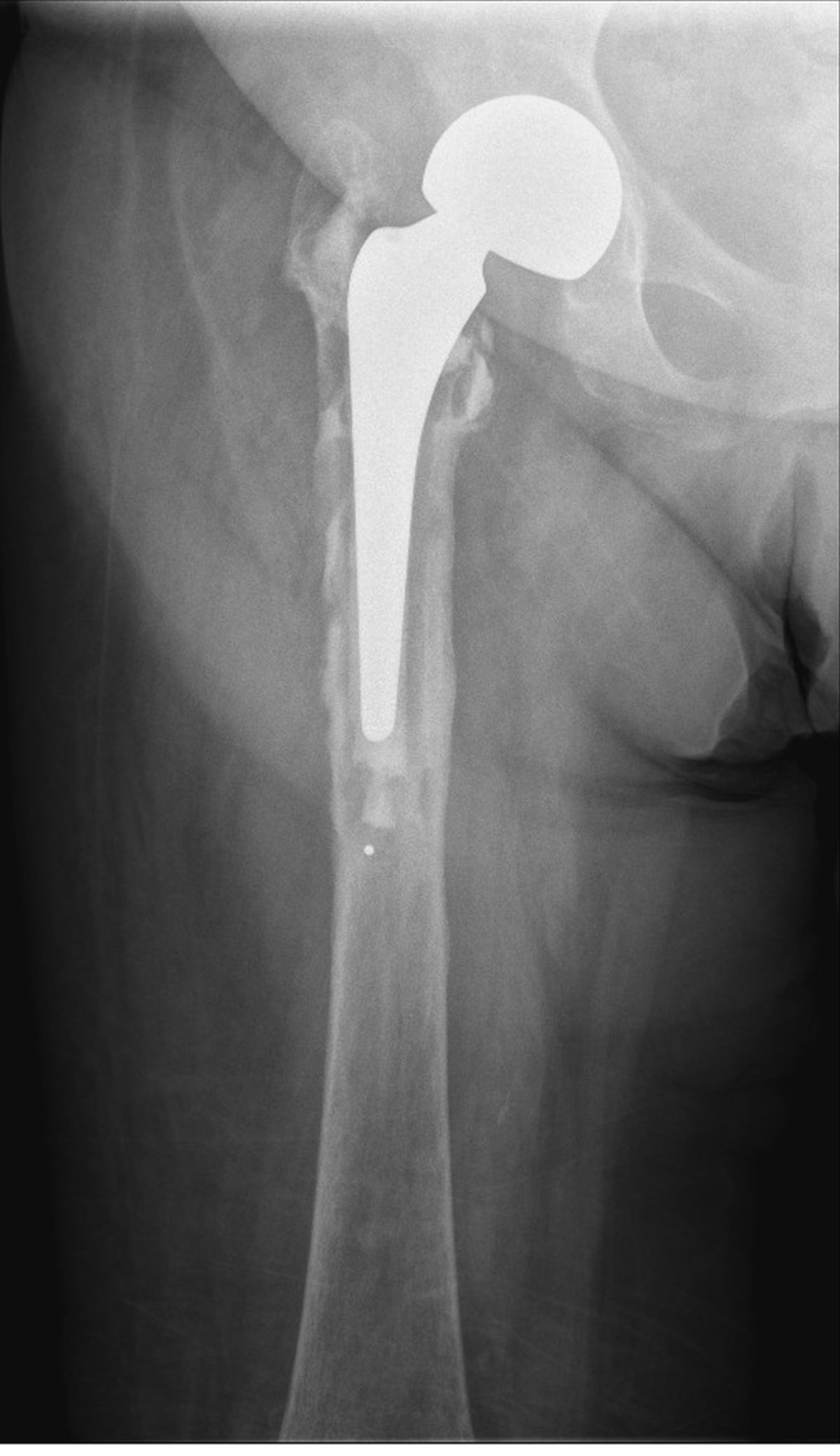 Pre-operative pelvic x-ray showing chronic prosthetic joint infection of a hip replacement with severe bone loss