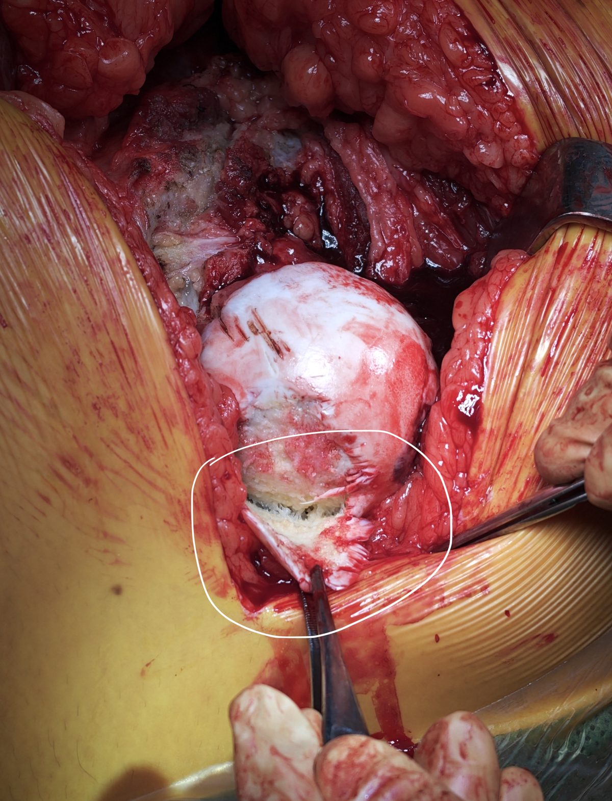 Intraoperative photograph during hip resurfacing for avascular necrosis showing a loose articular cartilage flap on the femoral head
