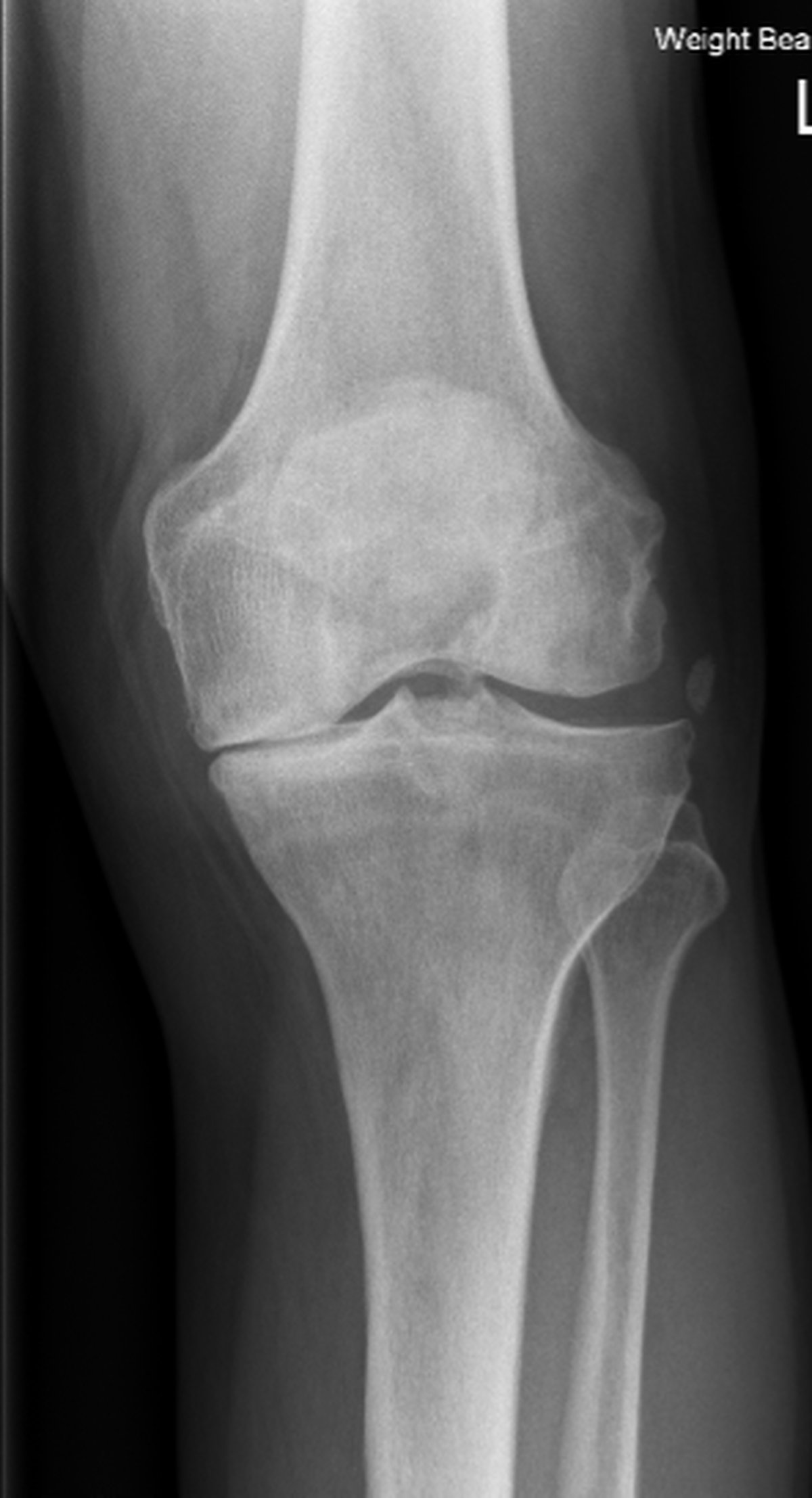 Pre-operative knee x-ray showing severe osteoarthritis of the knee with joint space narrowing